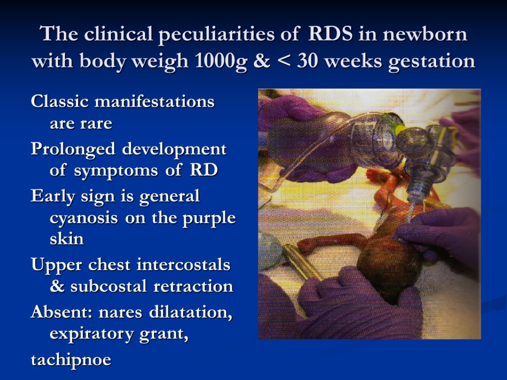 The clinical peculiarities of RDS in newborn with body weigh 1000g & < 30